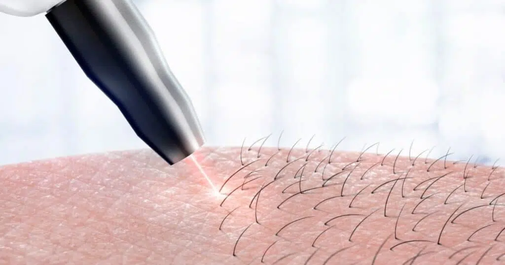 Οι 6 Μέθοδοι Αποτρίχωσης με + & - αποτρίχωση με lazer