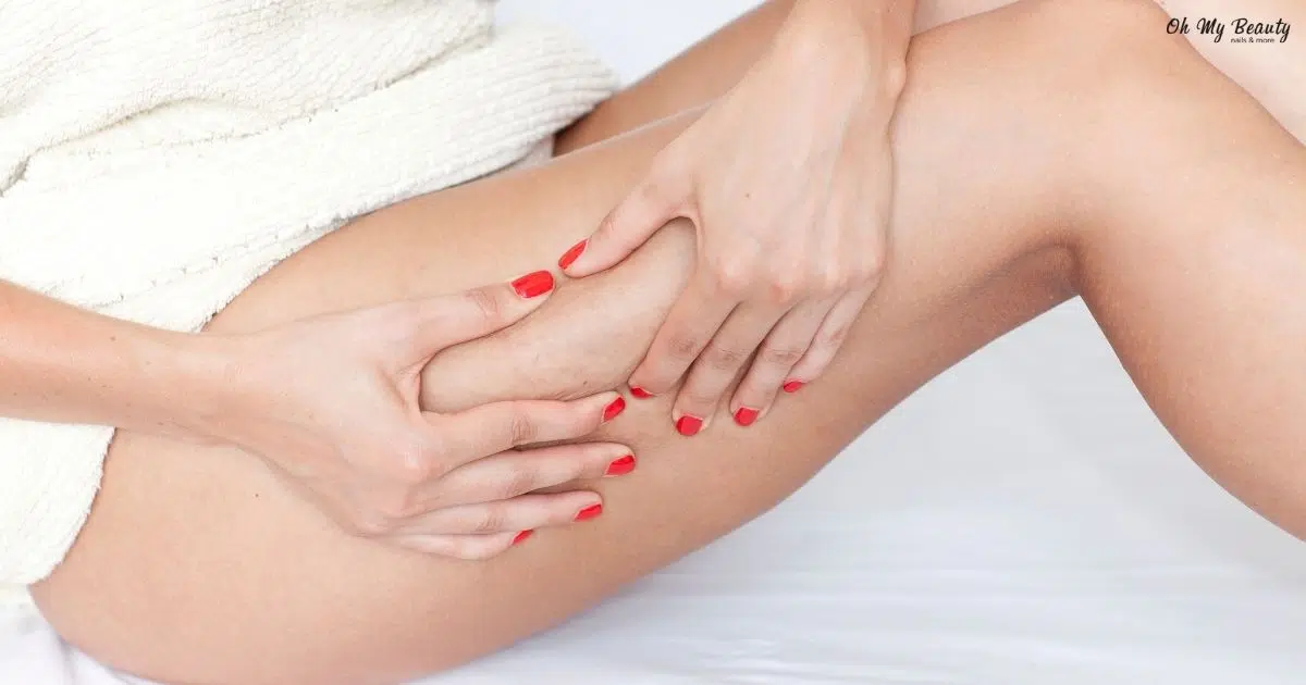 Κυτταρίτιδα: Αίτια & Αντιμετώπιση